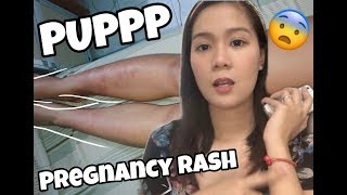 PUPPP RASH  PREGNANCY RASHES 😔  Marykane Vlogs [upl. by Gosser]