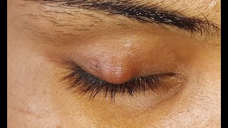 Chalazion Incision amp Curettage HD [upl. by Lateehs]