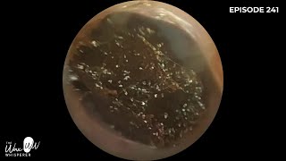 241  Ear Wax Removal in Stenotic Ear Canal using the WAXscope®️ [upl. by Elita]