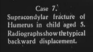 Recent advances in fracture treatment Part 5 c1932 [upl. by Chavaree823]