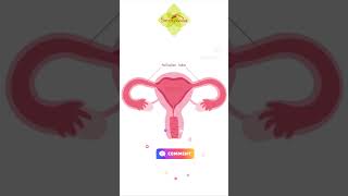 Fallopian tube blockage Treatment without operation fallopiantubeblockage uttarbastti infertility [upl. by Murry]