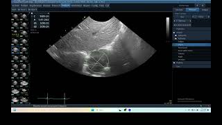 IQ 293 LUNG TUMOUR TFAST ULTRASOUND ECHOPAC ANALYSIS 2 [upl. by Talie]