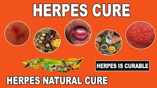 What You Need to Know about Herpes in 2022  minute [upl. by Chema]