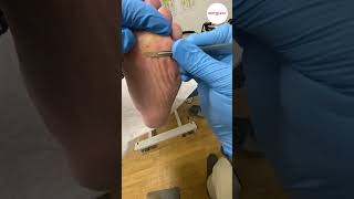 Corns on forefoot causing pain scalpel removal [upl. by Anna-Diane482]