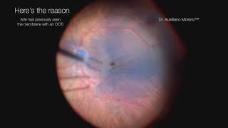 Patient with mild and thin epiretinal membrane with 2020 vision but complained of distortion [upl. by Dorahs]