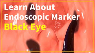 Learn About Endoscopic Marker Black Eye Tattoo Ink for Marking of Gastrointestinal Lesions [upl. by Grimbald]