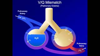 Hypoxia and Hypoxemia Mechanisms and Etiologies ABG Interpretation  Lesson 18 [upl. by Yrhcaz]