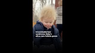 Baby Locks hair isnt styled its a rare condition uncombablehairsyndrome [upl. by Aleahpar]