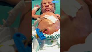 Infection Of Umbilical Cords medical newbornbaby [upl. by Caril124]