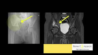 Treatment of Bone CancerEwings SarcomaPelvis HemipelvectomyLimb Salvage Surgery Dr Srimanth BS [upl. by Hinze]