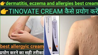 dermatitis eczema and allergies।।Tenovate cream।।best skin cream।।hindi review [upl. by Alick718]