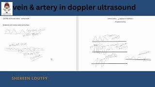 vein amp artery in Doppler ultrasound [upl. by Ylim]