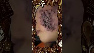 Blackheads Removal Acne Treatment and Very Satisfying Satisfying Pimple pop 372 blackheads [upl. by Horten]