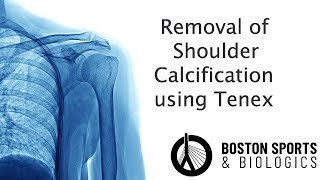 Shoulder Calcification Minimally Invasive Tenex [upl. by Lynna]