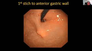 Update on endoscopic treatment for Achalasia with Haruhiro Inoue [upl. by Hurlee287]