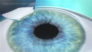 Femto LASIK  die sanfte und sichere LASIK [upl. by Navets]