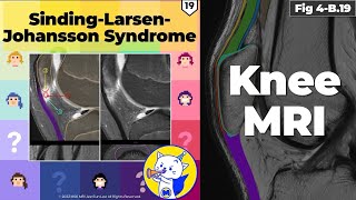 Fig 4B19 SindingLarsenJohansson Syndrome [upl. by Anawik]