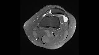 Trochlear dysplasia [upl. by Ilenay]