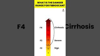 What is the danger range for FibroScan  Fibroscan  Liver Fibrosis Treatment viral hepatitis [upl. by Nedroj]