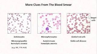 Anemia Lesson 4  Clues from the blood smear [upl. by Idnyl870]