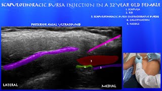 Ultrasound Guided Scapulothoracic Bursa Injection in a 32 Year Old Female by probeultrasoundcom [upl. by Louanna]