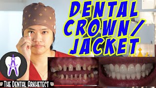 Dental Crown  Jacket Ano at Para Saan DentalCrown Jacket dental [upl. by Hannazus]