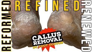 Reformed Refined Renewed Callus Removal For A Chef Serving The Homeless Great Story [upl. by Bridge]