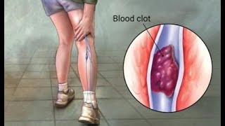 DVT with IVC Filter CDT [upl. by Astra]