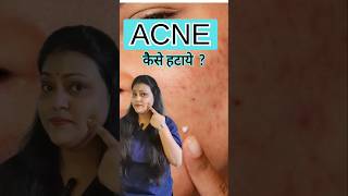 Homeopathic medicine for acne youtubeshorts acne acnetreatment [upl. by Sager229]