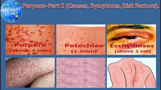 Purpura Part 2 Causes Symptoms Risk Factors [upl. by Noryahs]