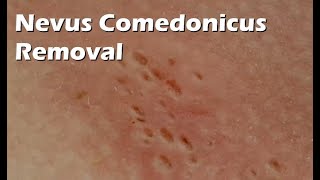 Nevus Comedonicus Removal  9 minutes worth [upl. by Oliana]