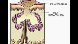 comedoni e pulizia parte1 [upl. by Noissap]