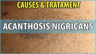 What is Acanthosis Nigricans Causes Symptoms and Treatments [upl. by Aleacem613]