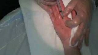 Palmar Hyperhidrosis Botox Procedure [upl. by Snehpets]