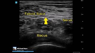 Femoral nerve block  Commenting on technique [upl. by Wauters]