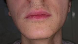 Lumenis Lightsheer Duet  male facial hair removal  1 year after [upl. by Wiltshire276]