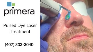 Pulsed Dye Laser Treatment [upl. by Atse]