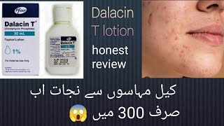 Dalacin t lotion honest review [upl. by Oiralednac]