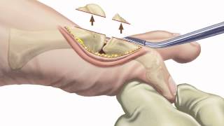 Arthritis of the Big Toe Diagnosis and Treatment at Holy Cross Orthopedic Institute [upl. by Allesiram]