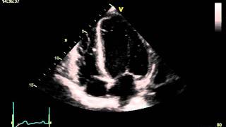 HYPERTENSIVE CARDIOMYOPATHY [upl. by Nilhtac]