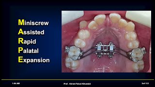 MARPE Miniscrew Assisted Rapid Palatal Expansion Live webinar [upl. by Assetal397]