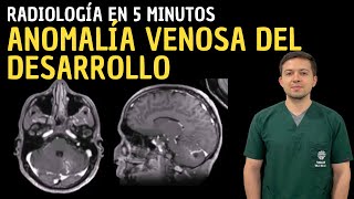 Radiología en 5 minutos Anomalía Venosa del Desarrollo [upl. by Dwane]