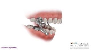 Herbst  Orthodontic Appliance [upl. by Lucho]