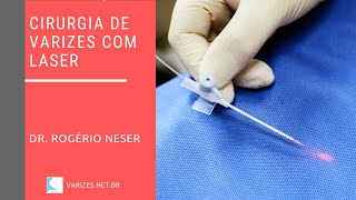 Cirurgia de varizes com laser [upl. by Imuyam]