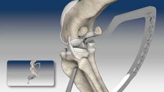 Reconstruction du Ligament Croisé Caudal avec NOVALIG® [upl. by Liba543]