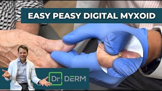 Easy Peasy Digital Myxoid  Dr Derm [upl. by Blight25]