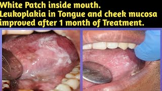 White Patch inside mouthLeukoplakia in Tongue and cheek mucosa improved after 1 month of Treatment [upl. by Annor]