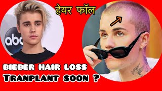 JUSTIN BIEBER RECEDINGHairLineHairFallTRANSPLANTMINOXIDILFINASTERIDEresultshindiCelebrity [upl. by Griffis]