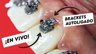 COLOCACIÓN DE BRACKETS DE AUTOLIGADO EN VIVO  INSTALACION DE ORTODONCIA COMPLETA [upl. by Gulick811]