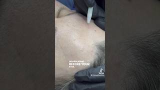 Cherry Angioma Removal procedure in action advancedskincare advancedelectrolysis cherryangioma [upl. by Baudelaire]